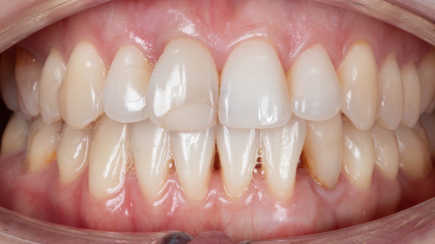 Stable root coverage result at 7-year follow-up