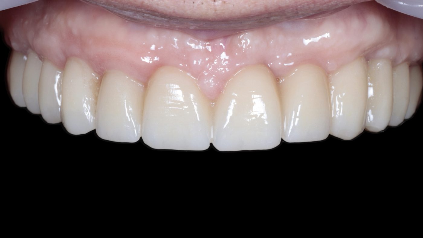 Natural-looking Full-Arch FP1 result at 3-year follow-up