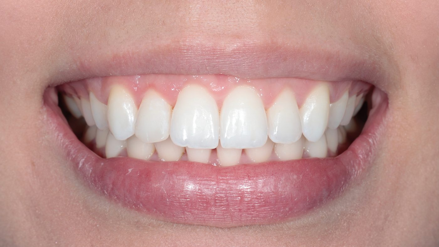 Balanced gingival architecture and whitened result after aesthetic crown lengthening