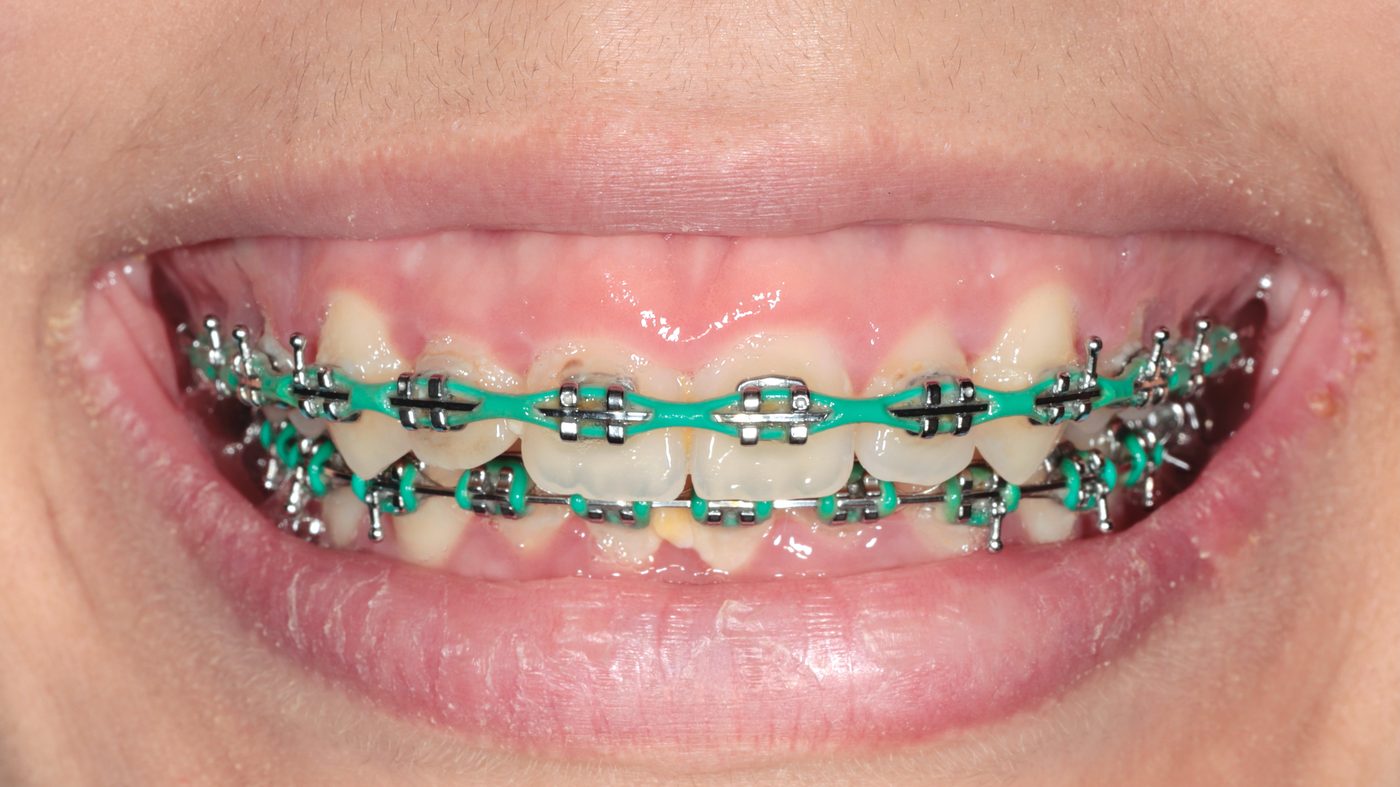 Uneven gingival display prior to aesthetic crown lengthening, shown at orthodontic debonding