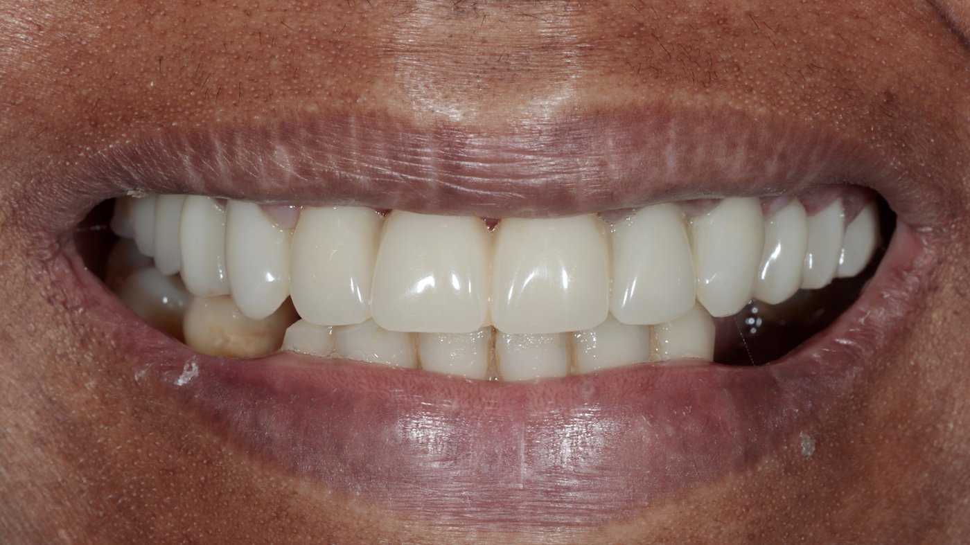 FP1 provisional restoration at 15 days, natural aesthetic result