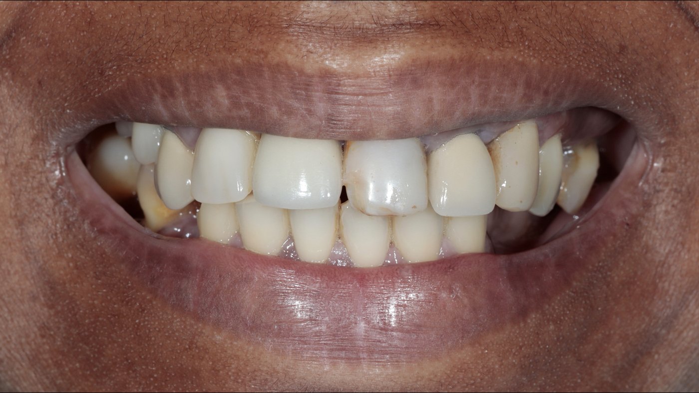 Severely worn and fractured residual dentition prior to Full-Arch FP1 rehabilitation