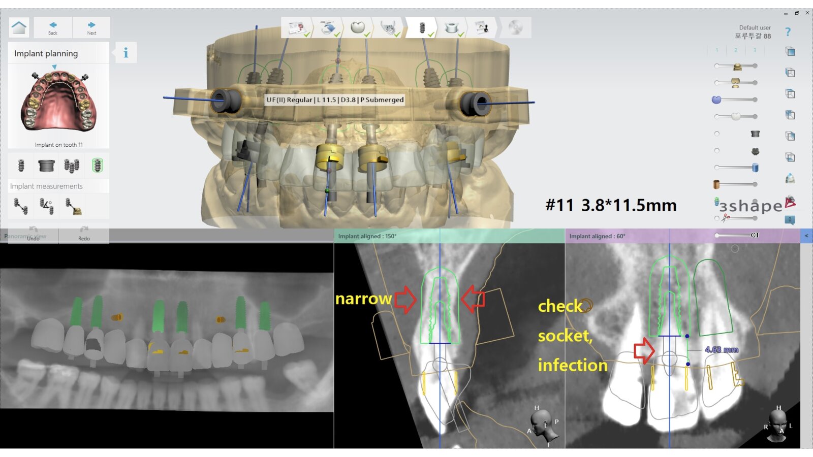 CBCT and 3Shape digital implant planning used to assess bone anatomy, implant position and prosthetic constraints