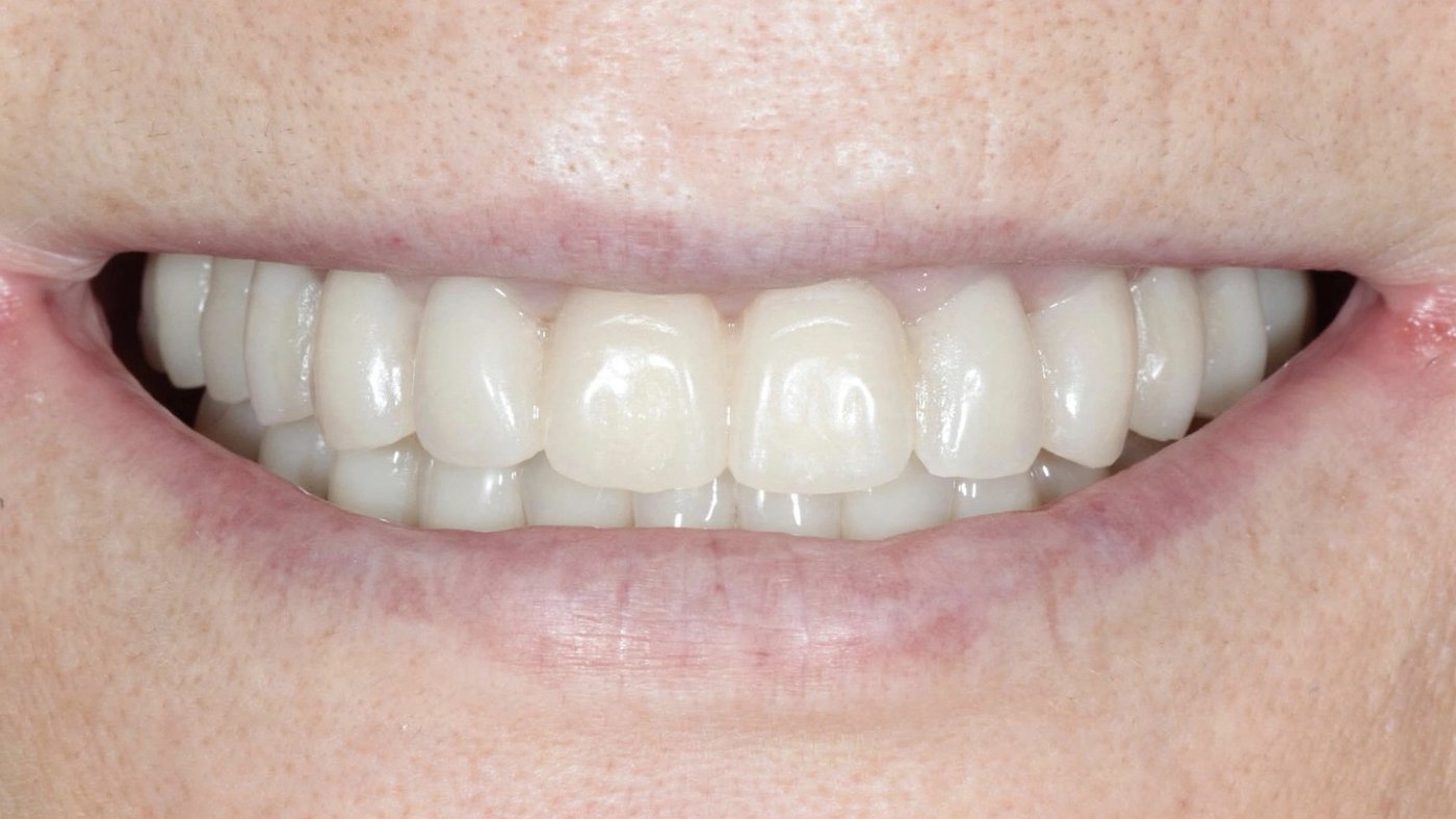Full-arch FP1 case, anterior view, showing the transition zone between tissue and restoration